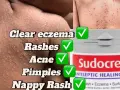 Sudocrem na pryszcze: Czy działa? Jak stosować bezpiecznie?