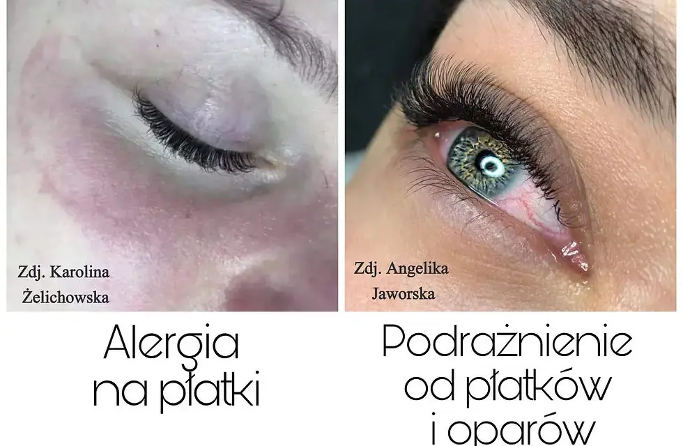 Alergia na rzęsy: objawy, kiedy występuje i co robić?