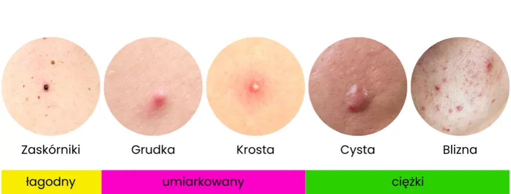 Cera trądzikowa: Kompleksowy przewodnik po pielęgnacji i leczeniu