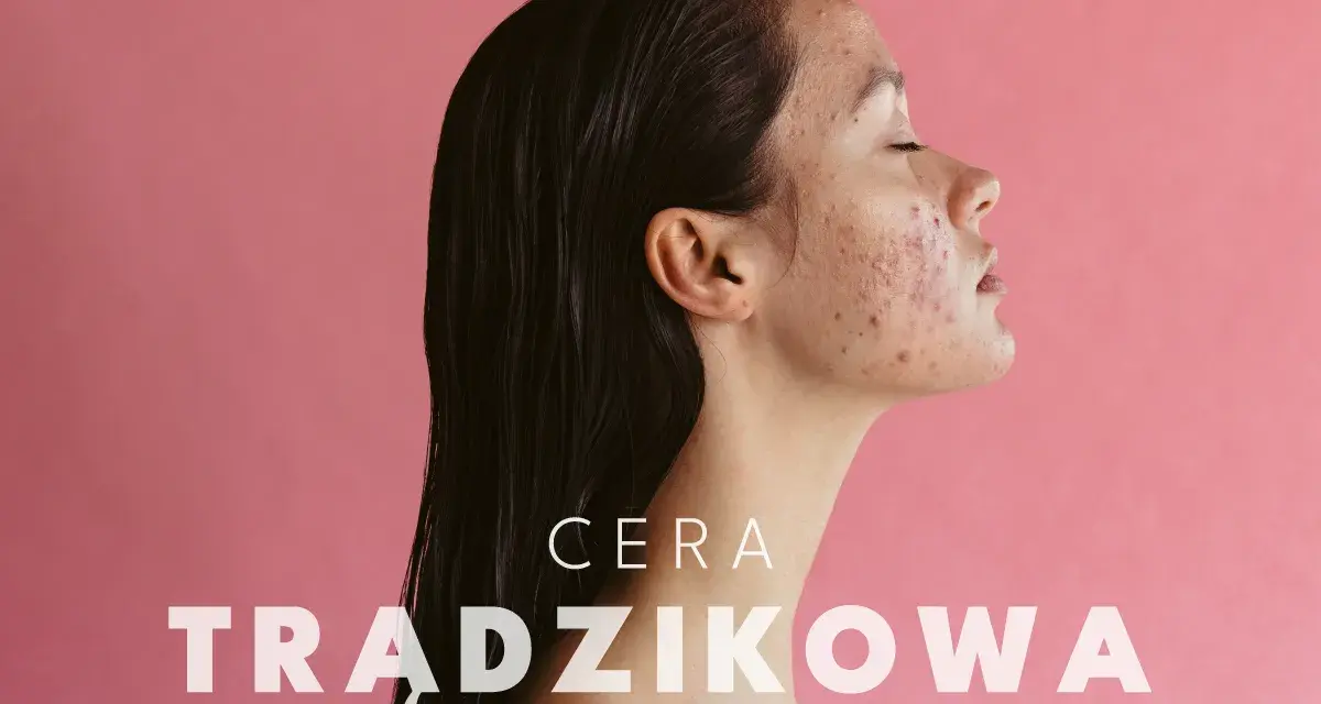 Cera trądzikowa: Jak skutecznie poprawić jej stan? Poradnik