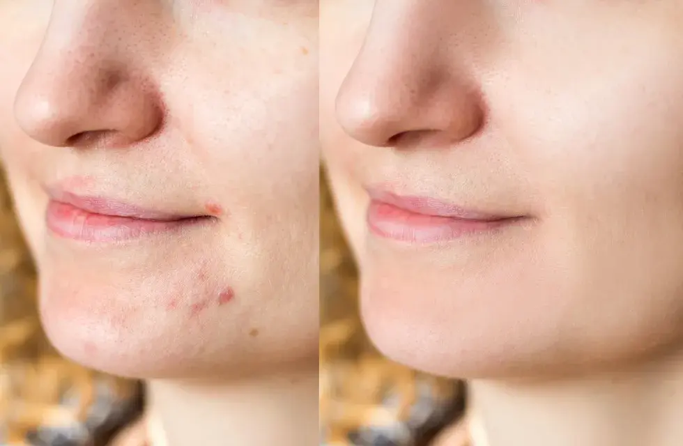 Pasta na pryszcze? Dermatolodzy ODRADZAJĄ! Poznaj fakty i alternatywy