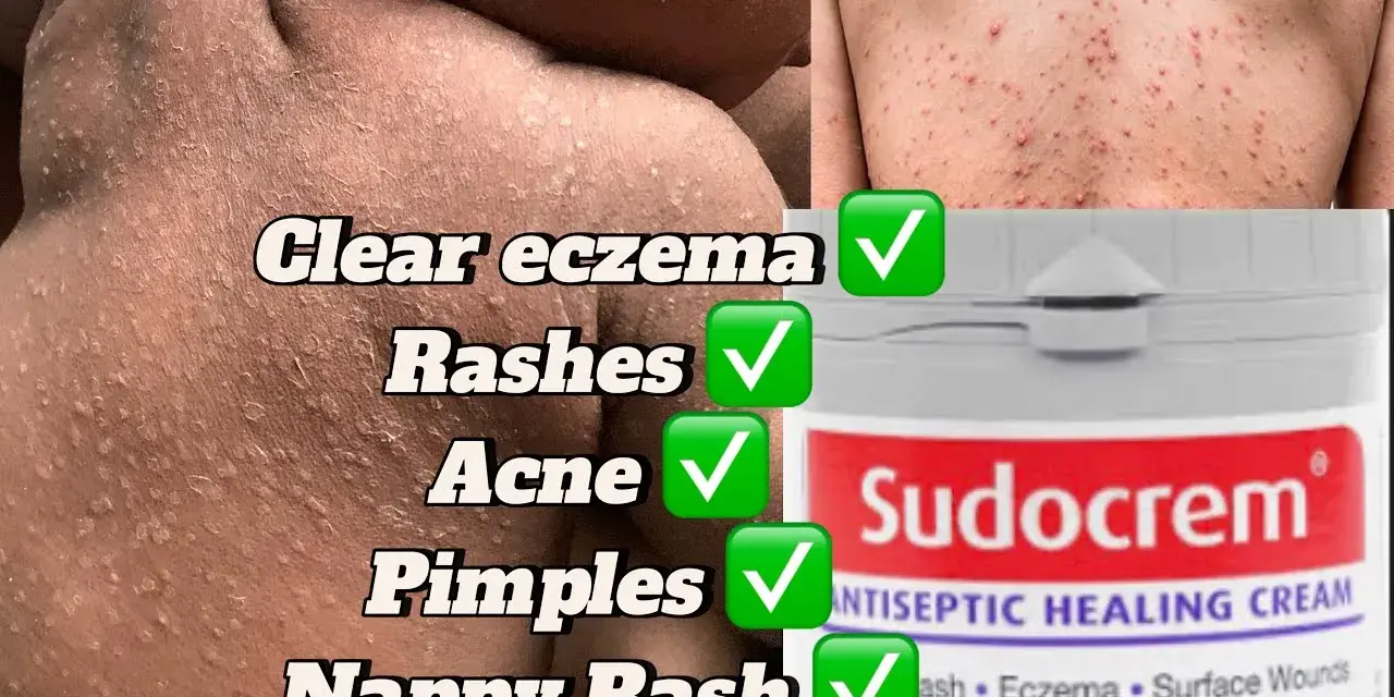 Sudocrem na pryszcze: Czy działa? Jak stosować bezpiecznie?