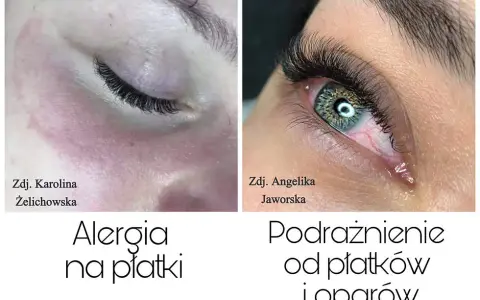 Alergia na rzęsy: objawy, kiedy występuje i co robić?