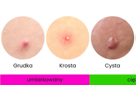 Cera trądzikowa: Kompleksowy przewodnik po pielęgnacji i leczeniu