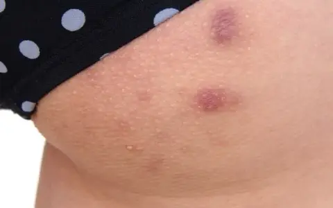 Pryszcze na nogach: przyczyny, leczenie i jak się ich pozbyć