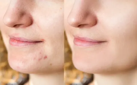 Pasta na pryszcze? Dermatolodzy ODRADZAJĄ! Poznaj fakty i alternatywy