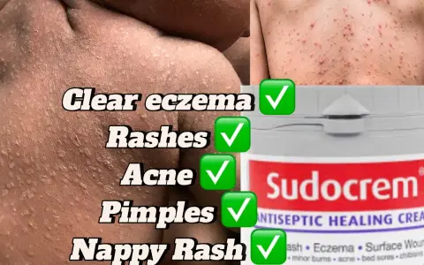 Sudocrem na pryszcze: Czy działa? Jak stosować bezpiecznie?