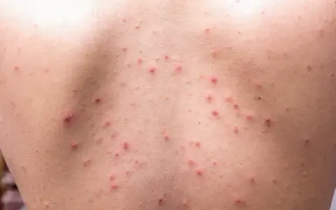 Jak pozbyć się pryszczy na plecach? Kompleksowy poradnik