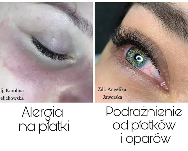 Alergia na rzęsy: objawy, kiedy występuje i co robić?