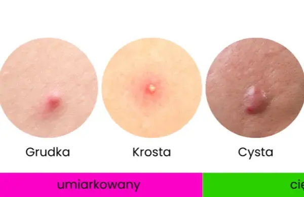 Cera trądzikowa: Kompleksowy przewodnik po pielęgnacji i leczeniu