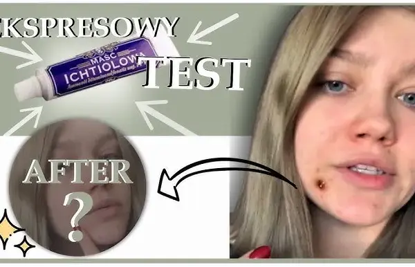 Jak długo trzymać maść ichtiolową na pryszczu? Sprawdź!