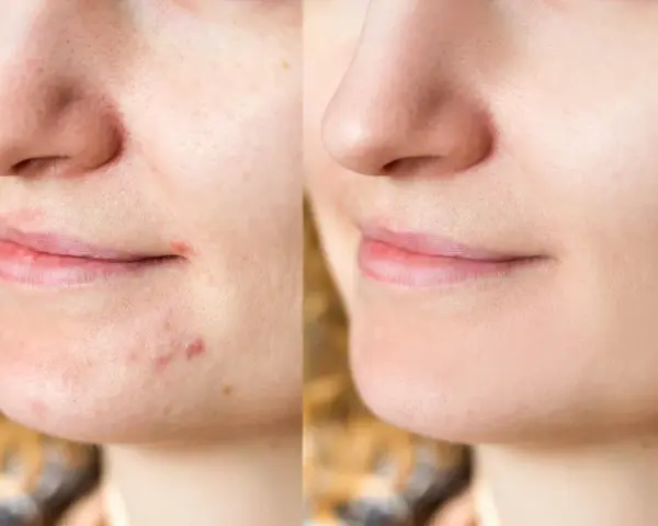 Pasta na pryszcze? Dermatolodzy ODRADZAJĄ! Poznaj fakty i alternatywy