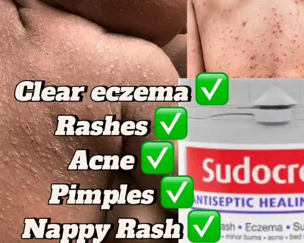 Sudocrem na pryszcze: Czy działa? Jak stosować bezpiecznie?