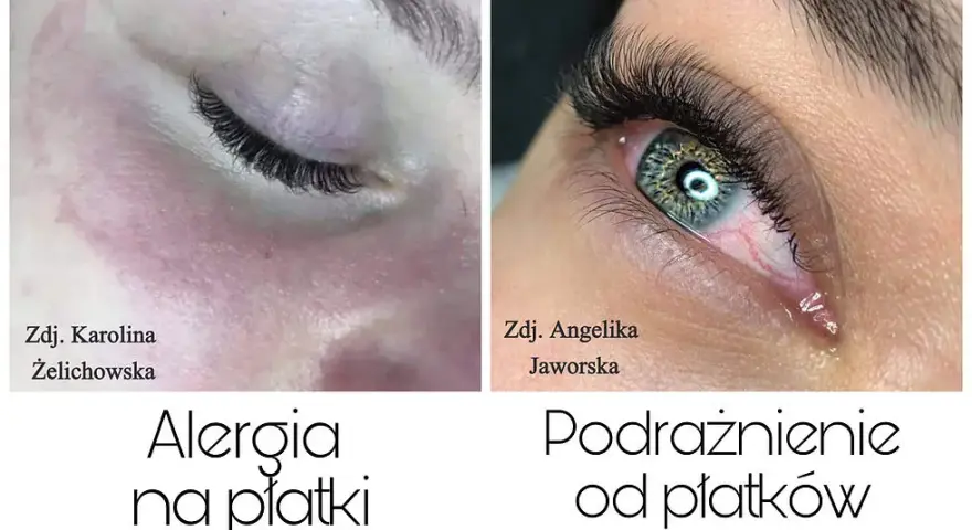 Alergia na rzęsy: objawy, kiedy występuje i co robić?