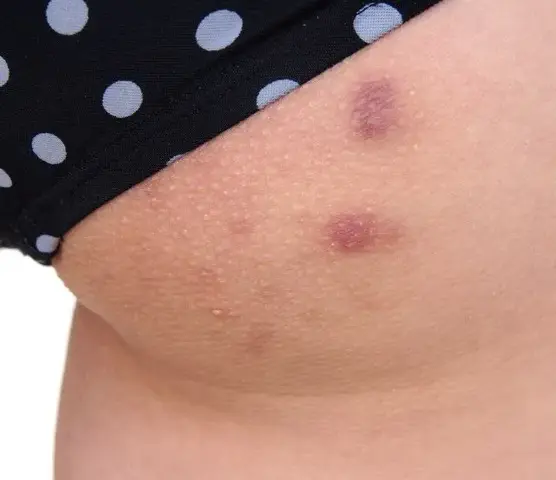 Pryszcze na nogach: przyczyny, leczenie i jak się ich pozbyć