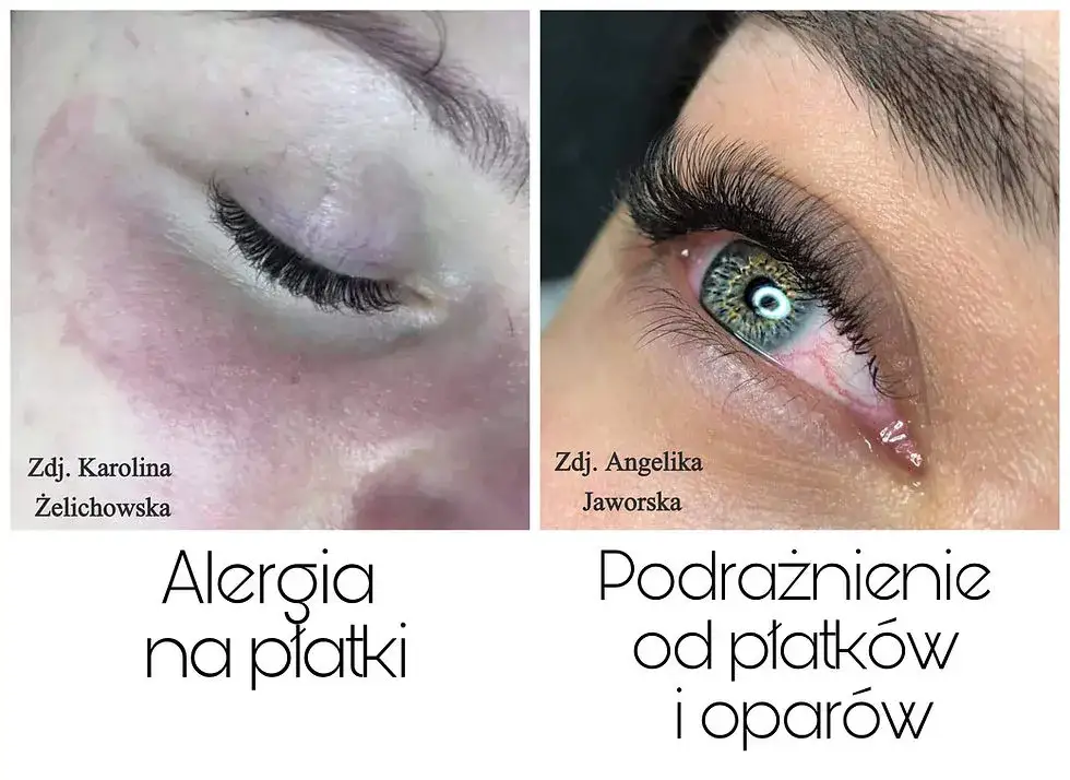 alergia na rzęsy objawy porównanie podrażnienie