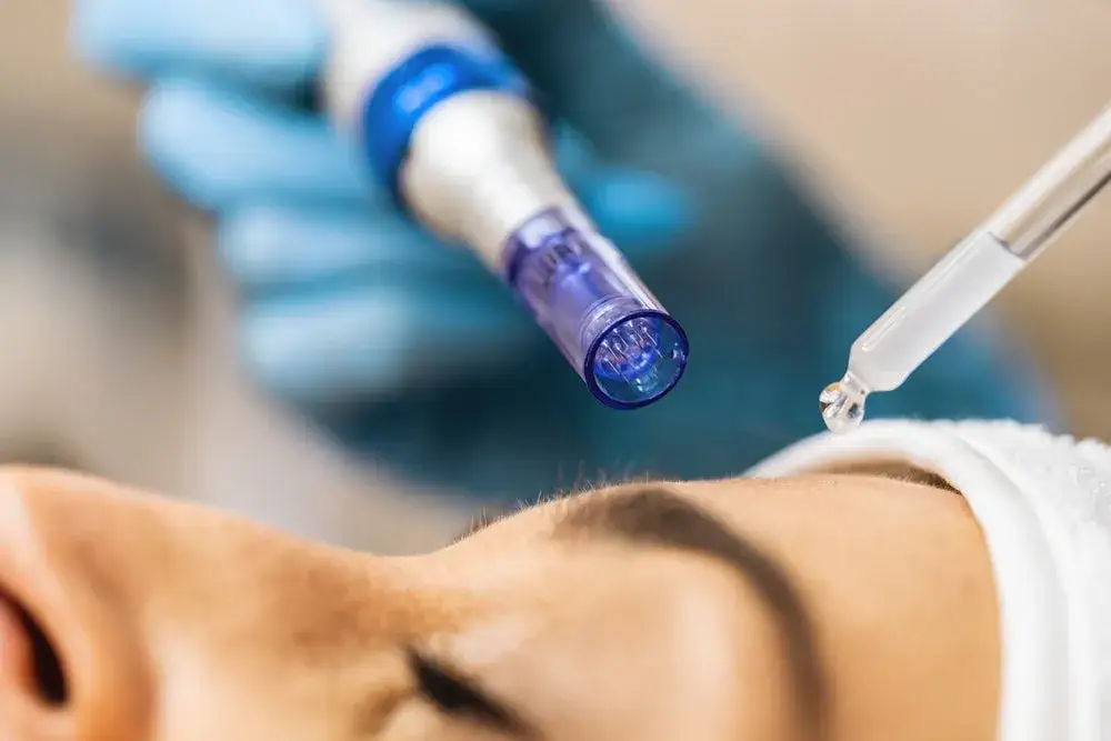 zabiegi na przebarwienia laser, peeling chemiczny, mikronakłuwanie