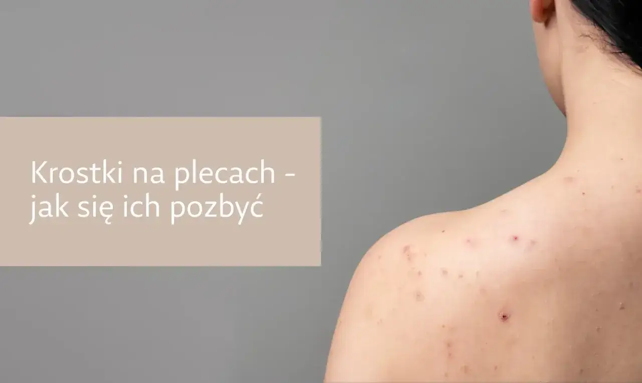 nawyki pogarszające trądzik na plecach
